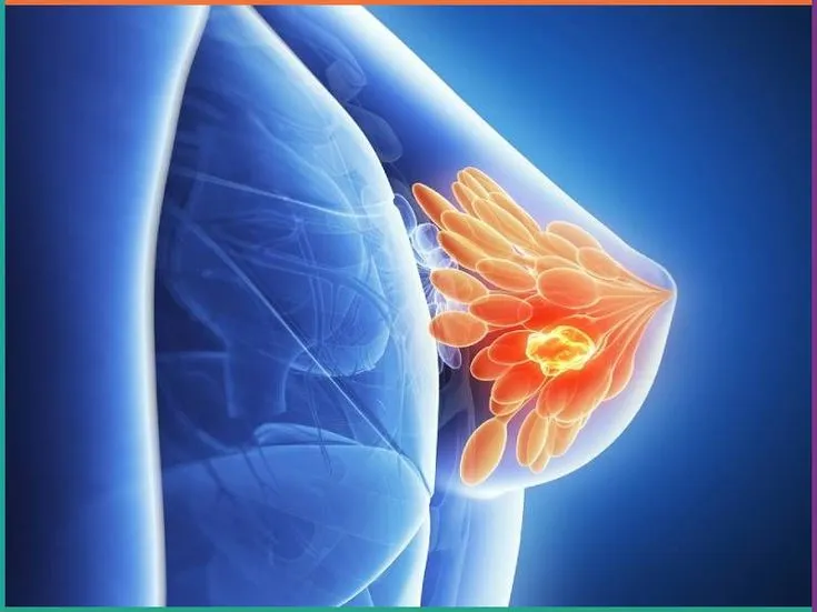 Breast Cancer Screening in Indore